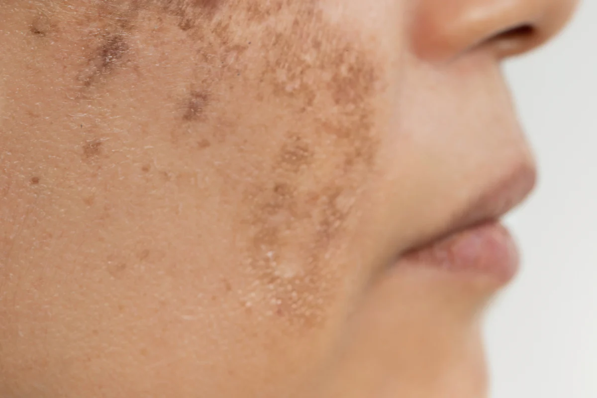 Treatments for Rough Skin Texture and Pigmentation