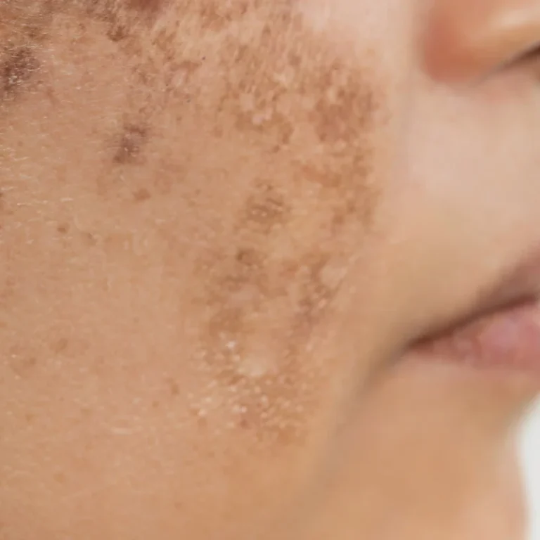 Treatments for Rough Skin Texture and Pigmentation