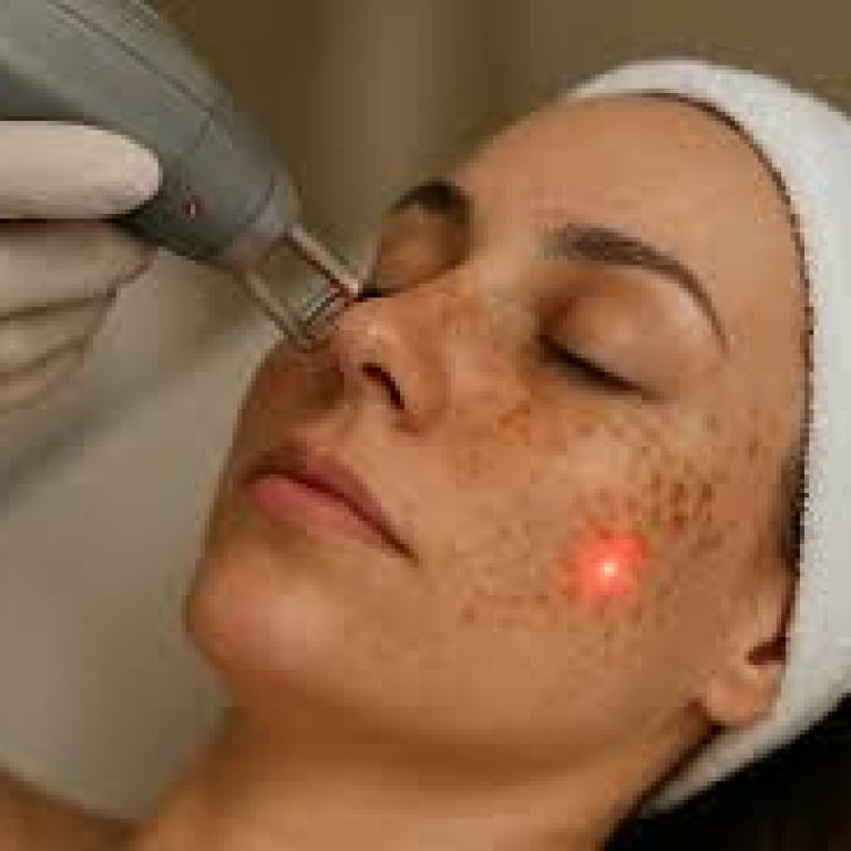 How to Remove stubborn pigmentation using advanced aesthetic Treatments